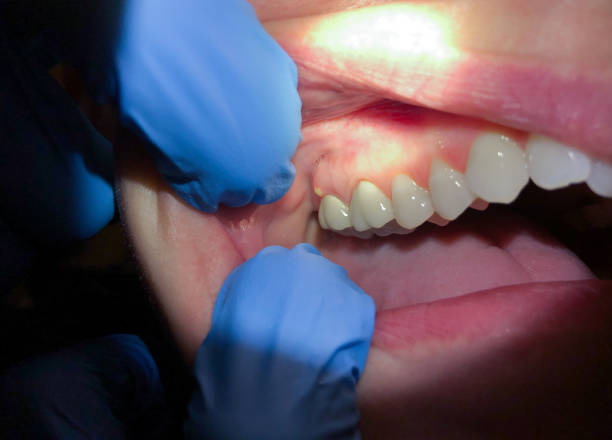 Best Same-Day Emergency Dentist in Rmichael, CA